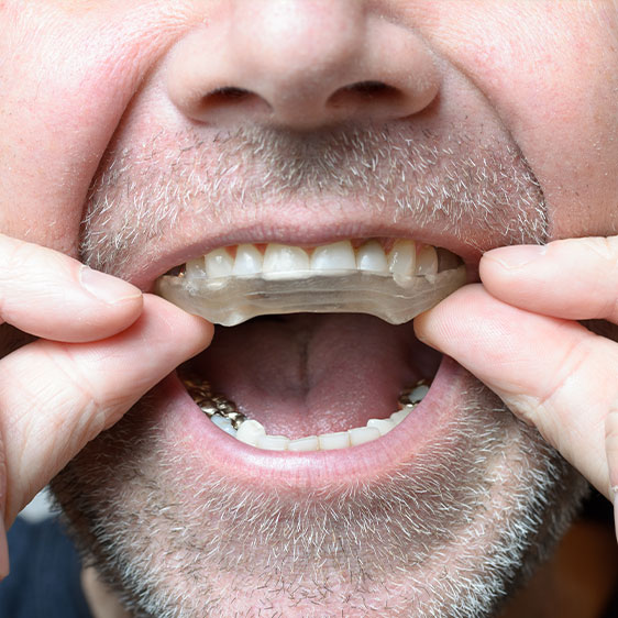 Bruxism TMJ TMD Therapy | My Family Dental | Okotoks General and Family Dentist