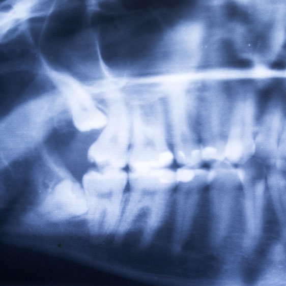 What are wisdom teeth | My Family Dental | Okotoks General and Family Dentist