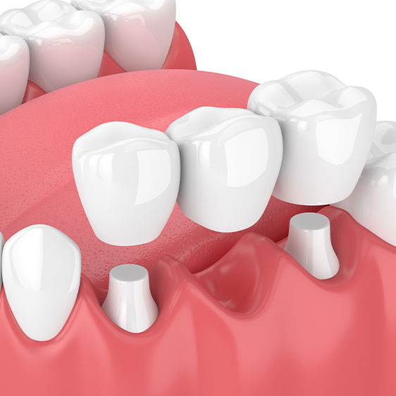 What is a dental bridge | My Family Dental | Okotoks General and Family Dentist