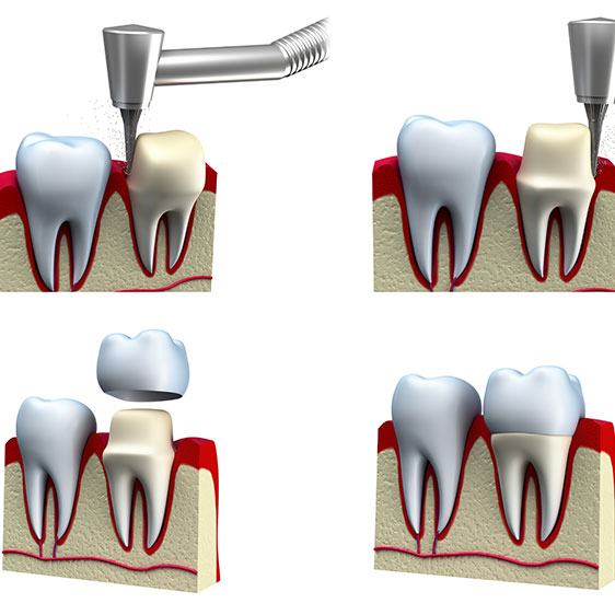 Dental Crowns Okotoks | My Family Dental | Okotoks General and Family Dentist