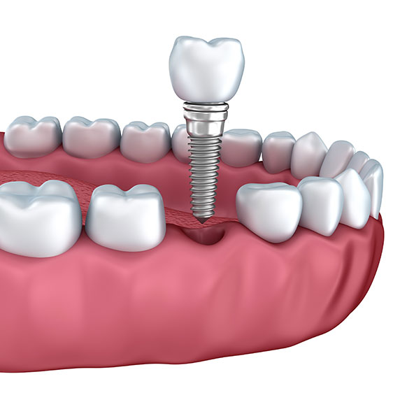 What is a dental implant | My Family Dental | Okotoks General and Family Dentist