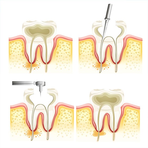 What is Root Canal Therapy | My Family Dental | Okotoks General and Family Dentist